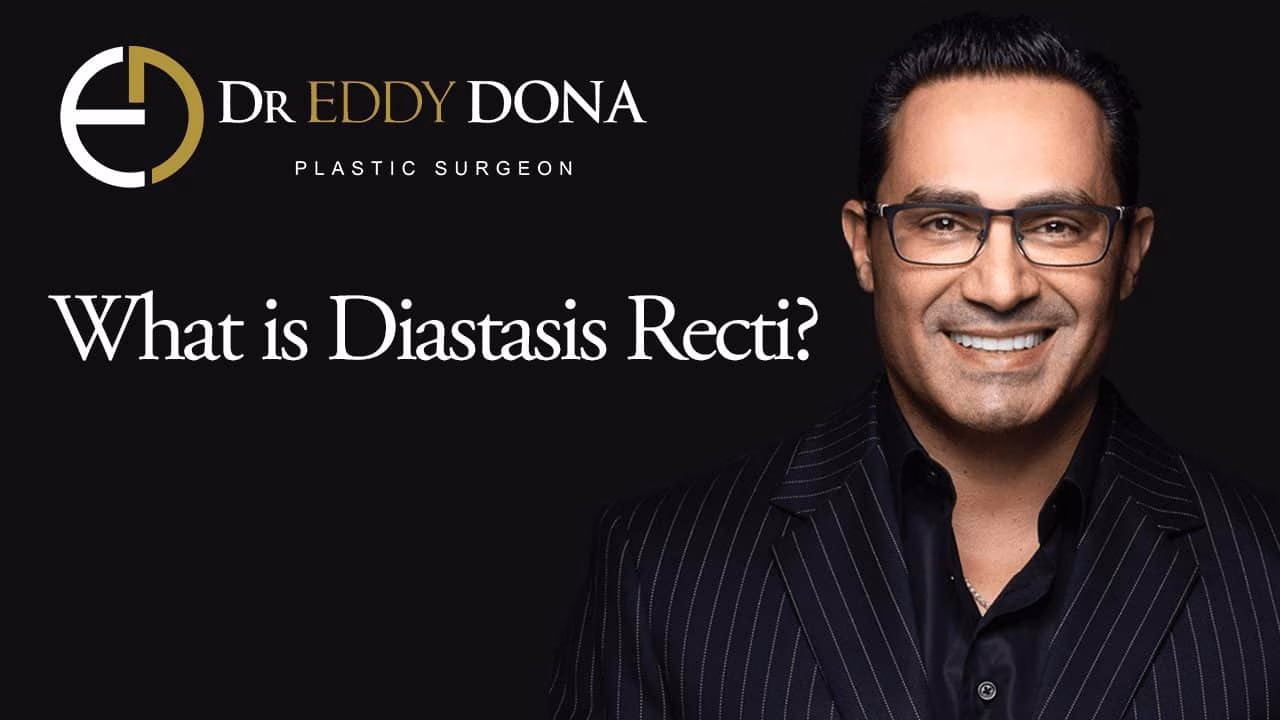 What is Diastasis Recti?